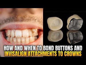 How and When to Bond Buttons and Attachments to Crowns