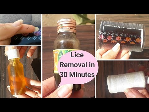 Lice Removal Treatment At home | Lice eggs, Nits, lice remedy- Remove lice from head - Glow Yourself