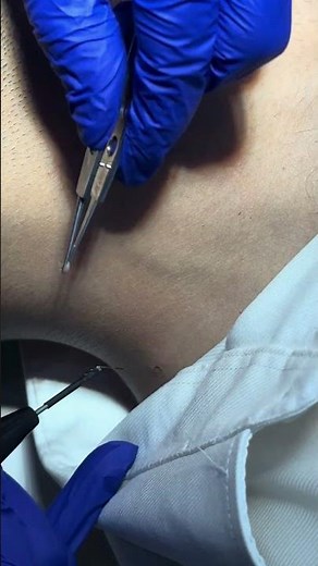 Skin tags removal | how to remove skin tags #cosmeticdermatology #beauty