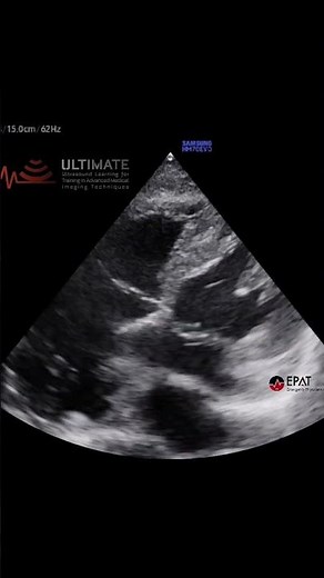 The Chiari Network in Bedside Ultrasound ULTİMATE #shorts #emergencymedicine #ultrasonography