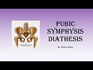 Pubic symphysis diathesis - causes, imaging findings, treatment