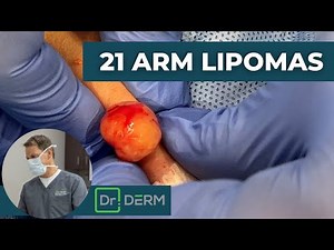 21 Arm Lipomas | Dr. Derm