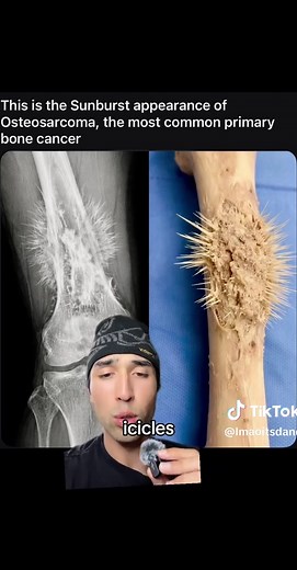 Osteosarcoma: The