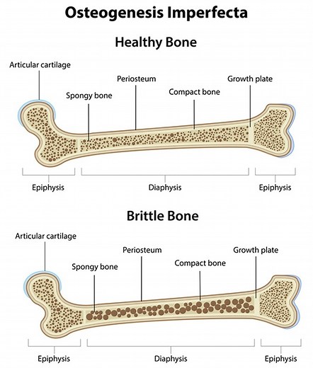 Types of Osteogenesis Imperfecta (OI) / Brittle Bone Disease
