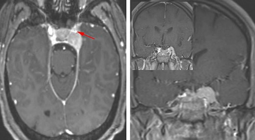 Cavernous Sinus Meningioma | Cohen Collection | Volumes | The Neurosurgical Atlas