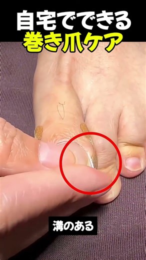 Ingrown toenail care you can do at home