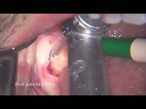 Lower third molar extraction