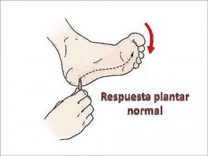 Signo de Babinski