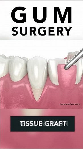 Receding Gums Surgery