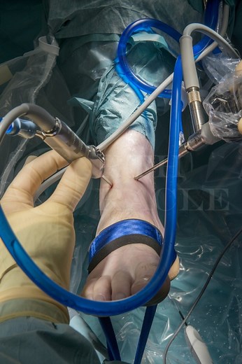 Ankle arthroscopy using non-invasive ankle distractor Surgical Technique - OrthOracle
