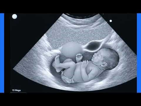 Ultrasound Imaging of Subchorionic Cyst at 15 Weeks Pregnancy: Findings, Diagnosis, and Prognosis