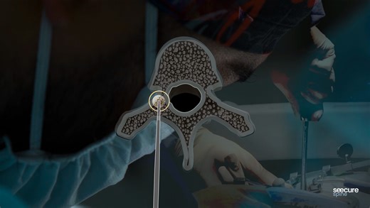 seecure surgery — The Last Few Millimeters | Solution Video