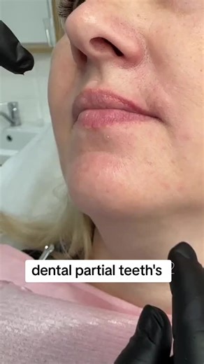 #procedure #fitting #crowns #foryoupage❤️❤️ #crowns #procedure