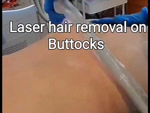 Anus Hair? Remove Them With Laser!