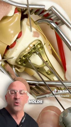 Should Bone Plates & Screws be removed? 🔩 Bone plates, pins and screws are highly engineered medical devices designed to help our bodies heal from bone damage and trauma, ensuring proper alignment and speedy recovery. Whether it's reconstructing a damaged joint or changing skeletal alignment, implants are the silent heroes of orthopedic surgery. From intramedullary rods to pins, these implants are designed to stay with us, providing strength and support. But what are these implants? They're dev