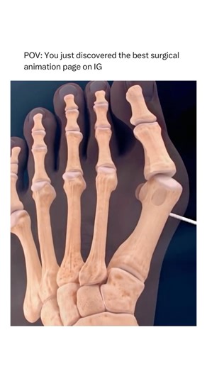 Animations | Follow @surgicalanimation for more! 🏥 | Instagram