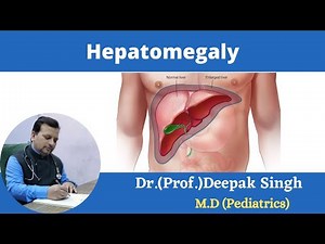 Hepatomegaly# Enlargement of liver # Deepak PD. Singh