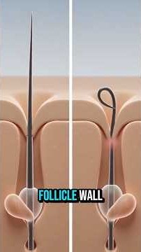 Why Ingrown Hairs Hurt More Than You'd Think 😳