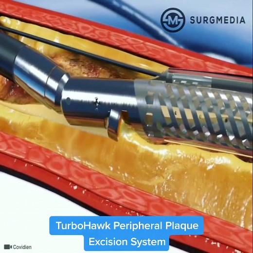 TurboHawk Peripheral Plaque Excision System: Directional Atherectomy for the treatment of Peripheral Arterial Disease (PAD) #technology #cardiology
