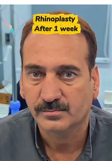 Transformative Rhinoplasty Results: Before and After