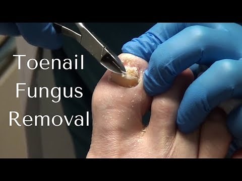 Toenail Fungus Removal - How to Cut Toenail Fungus