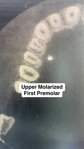 Understanding Upper Molarized First Premolar Anatomy
