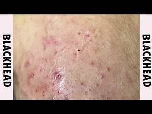 Relaxing Every day , Blackhead Removal 2025 , New Video blackhead remove