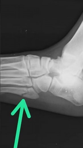 transverse fracture at the metaphyseal-diaphyseal junction involving the intermetatarsal joint