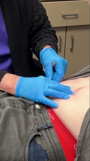 Sublocade Injection (Extended Release Buprenorphine)