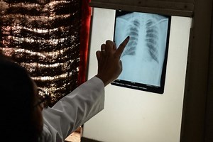 World TB Day | Civil society backs national plan