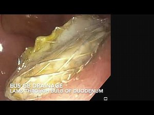 LAMS removal post EUS gallbladder drainage. Scope the inside of the gallbladder! Key teaching points