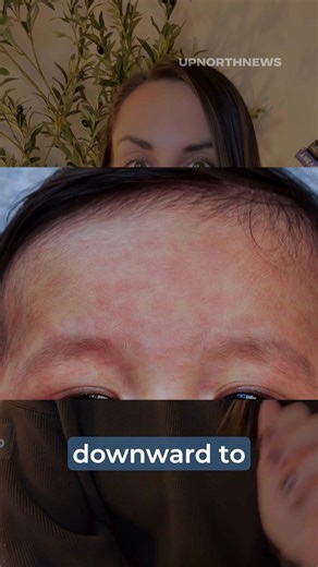 1.6K views · 11 reactions | Hey Wisconsinites! In this episode of Raising Wisconsin with Dr. Kellie, we’re talking about how to spot the signs of measles in kids. Learn what early symptoms to watch for and when to call your healthcare provider. Stay up to date by subscribing to our free daily newsletter at the  in comments ⬇️ | UpNorthNews | Facebook