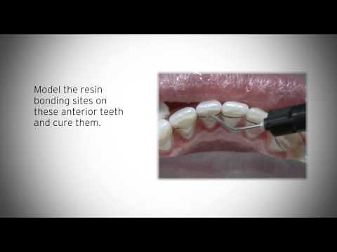 The first CAD/CAM digital lingual retainer MEMOTAIN - Clinical Case Part 1