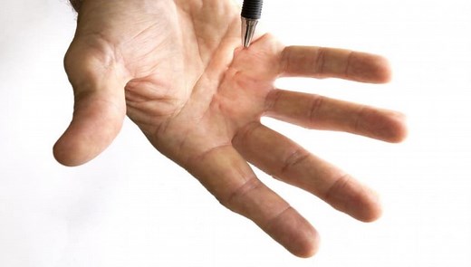 Acupuncture for Dupuytren’s Contracture