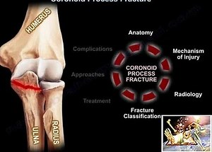 Coronoid Process Fracture - Everything You Need To Know - Dr. Nabil Ebraheim