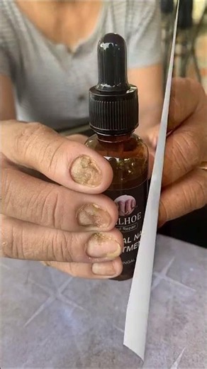 Tinh chất trị nấm móng s1