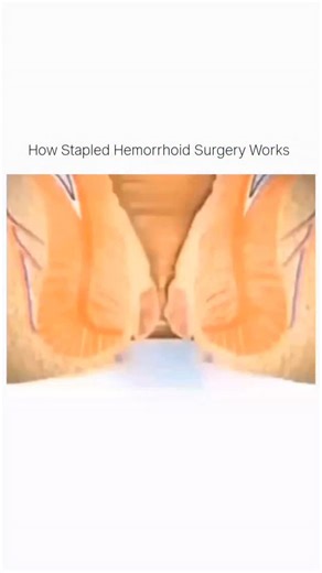 Science | Stapled hemorrhoid surgery is a modern procedure used to treat piles with less pain and faster recovery. Instead of cutting the... | Instagram