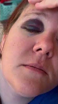 Ashley's eye two days later. Go back and look at the other videos, it explains what happened