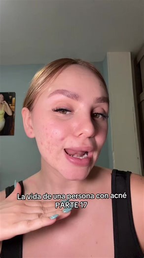 Limpieza facial correcta para piel con acné - VALENISIS