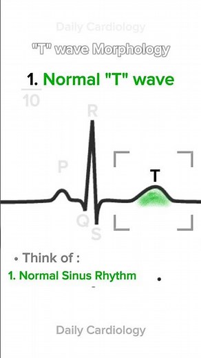 ECG comparison (T wave Morphology) #ecg #ecginterpretation #ekg #cardiology