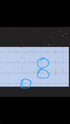 He has inferior ST elevation. He has lateral ST elevation. Most people stop there. But V1–V3 show horizontal ST depression with tall R waves. That’s not “just reciprocal.” That’s posterior myocardium dying. Posterior extension means a larger infarct. More muscle. More dysfunction. More danger. If you see inferolateral STEMI, always scan V1–V3 carefully. Ask yourself: Is this depression? Or is this elevation from the back of the heart? Mirror thinking saves myocardium. This ECG: Inferior STE: II,