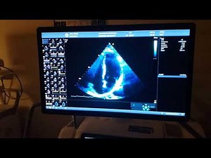 Echocardiogram Ultrasound Imaging Test