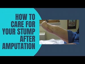 How to Care for Your Stump After Amputation