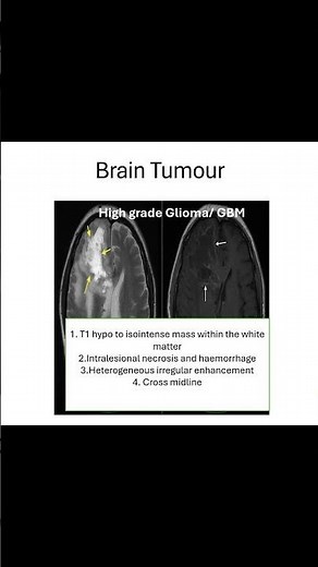 Brain Tumor Diagnosis Made EASY #medicaleducation