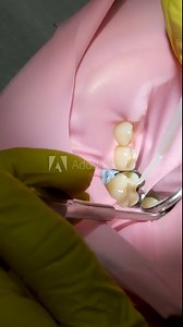 Dentist and assistant drilling tooth in dental clinic. Close-up shot of unrecognizable female patient wearing rubber dam and getting dental treatment. High quality 4k footage