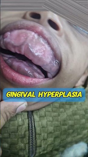 Gingival or Gum hyperplasia | side effect of epilepsy drugs