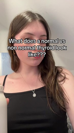 Understanding Hyperthyroidism Symptoms and Diagnosis