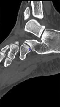 Accessory Ossicle vs Fracture in Foot#msk#mri#foot#pain#fracture#athlete#trauma#injury#rehab