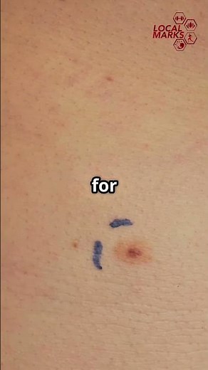 How to Check for Skin Cancer at Home?