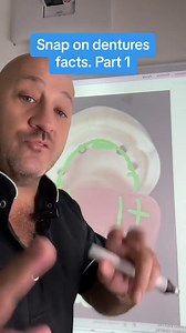 Here are some important FACTS you need to know about the "Snap-on Dentures": 1. Coverage of the Upper Palate: - One of the primary challenges with "snap-on dentures" is that they typically maintain coverage of the upper palate. This is due to the way these prosthetics are designed, with a palate component that can be uncomfortable for some patients. This palate coverage can cause sensations of bulkiness in the mouth and, in some cases, interfere with pronunciation and the perception of food tast